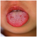 イチゴ舌
